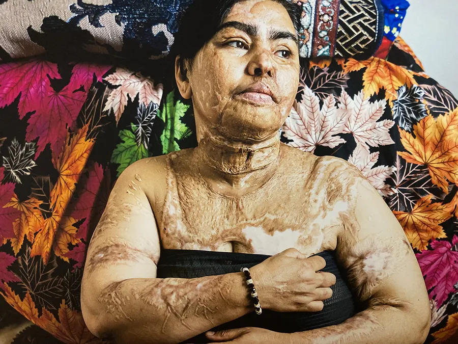 Víctima de un ataque con ácido, de Hootan Babapourvajari (Irán) 